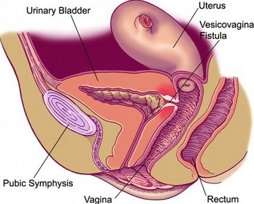 علائم فیستول وزیکوواژینال - دکتر دانش پژوه