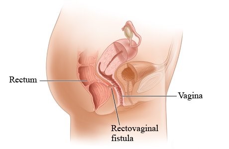فیستول رکتوواژینال چیست؟ دکتر دانش پژوه