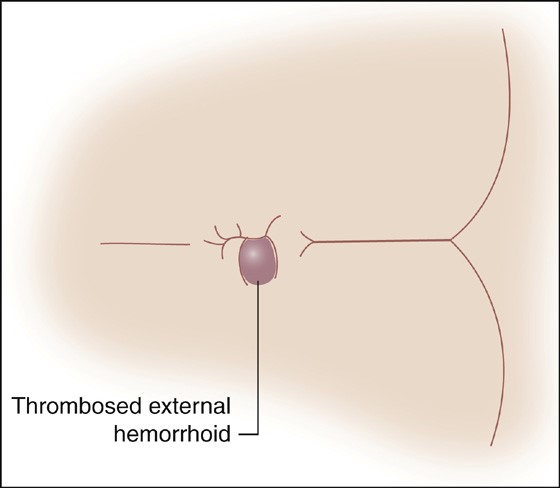 روش های مختلف درمان هموروئید ترومبوزه