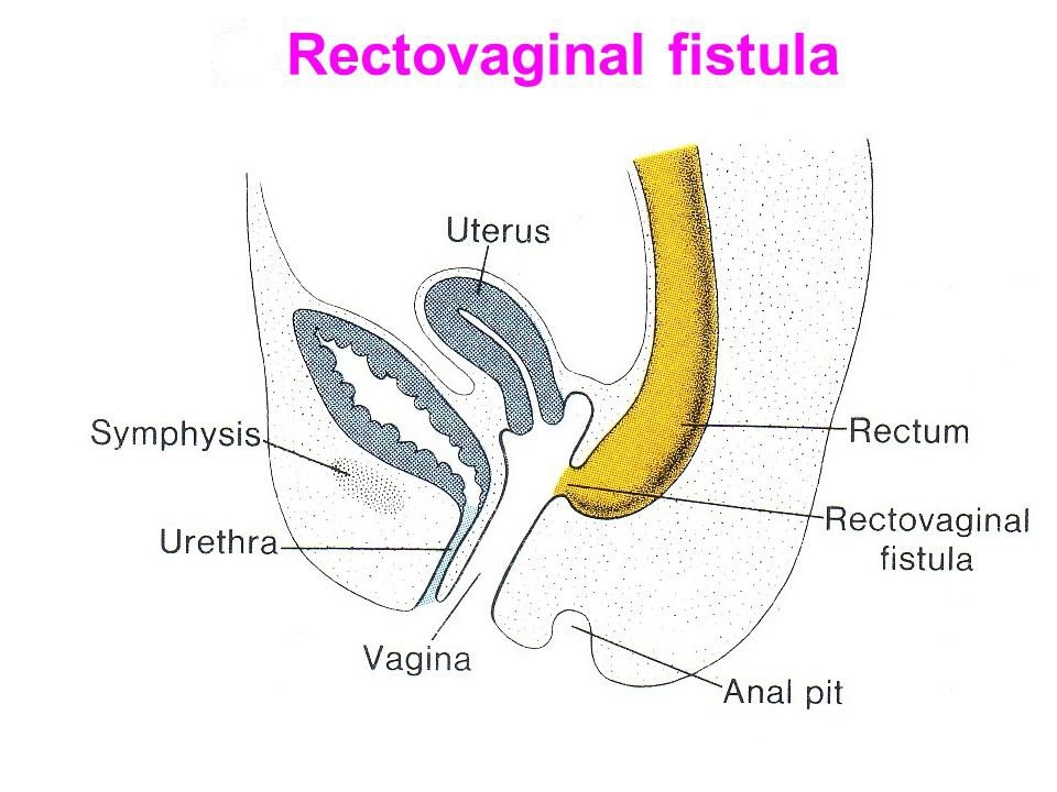 درمان فیستول رکتوواژینال چیست؟ دکتر دانش پژوه