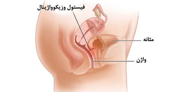 درمان های خانگی فیستول رکتوواژینال با دکتر دانش پژوه