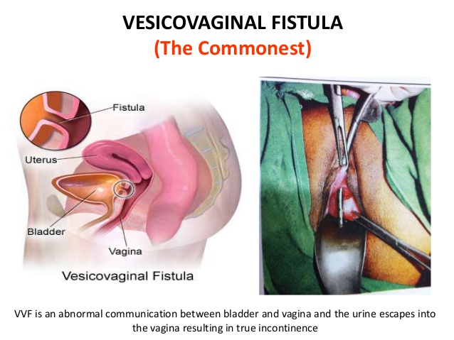 تشخیص فیستول واژن آسان است؟ دکتر دانش پژوه