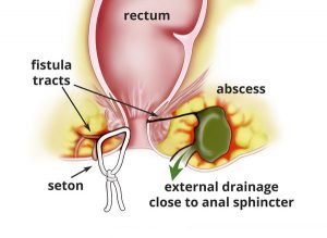 عوارض جراحی فیستول مقعدی - دکتر دانش پژوه