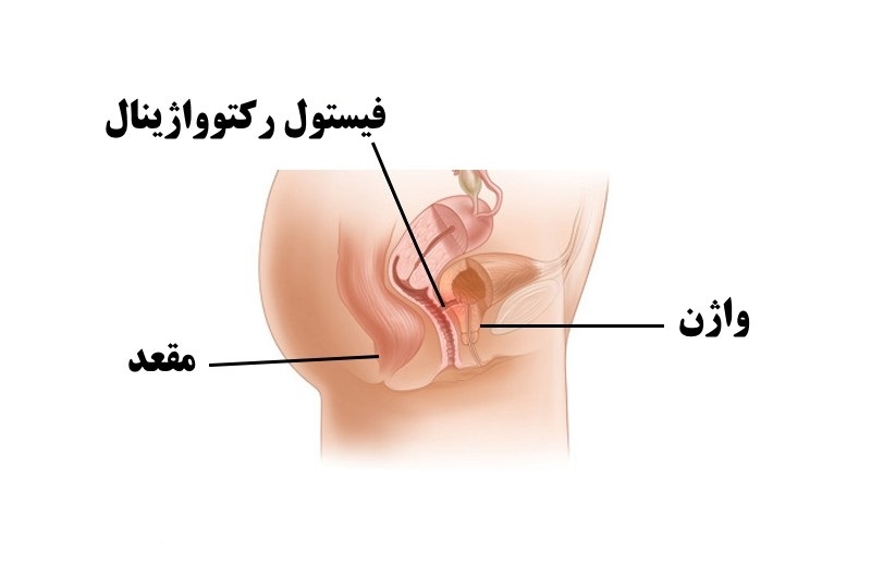 فیستول زایمان چیست؟ دکتر دانش پژوه