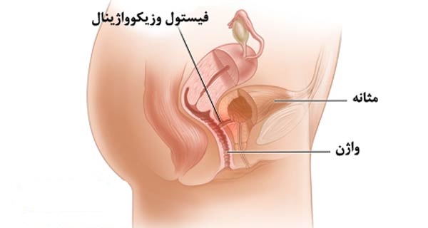 علت فیستول زایمان چیست؟ دکتر دانش پژوه