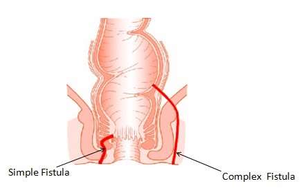 بیماری فیستول در مردان چیست؟ دکتر دانش پژوه