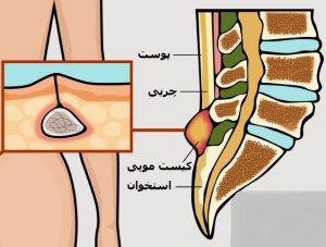 درمان کیست مویی با لیزر - دکتر دانش پژوه