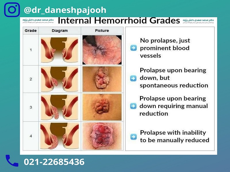 بواسیر داخلی چیست؟ - دکتر دانش پژوه