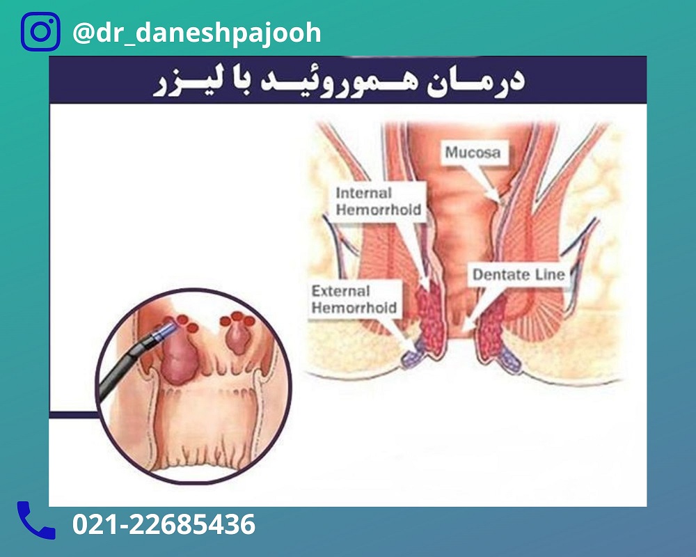 عمل بواسیر - لیزر بواسیر - لیزر هموروئید - دکتر دانش پژوه