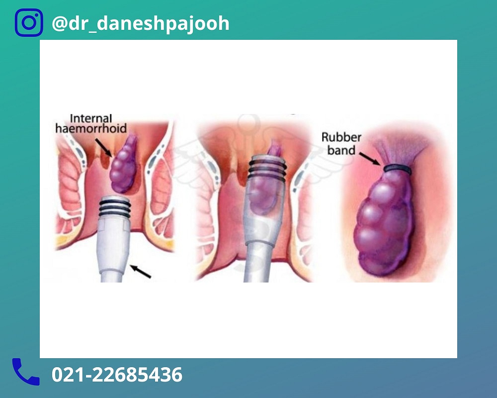 عمل بواسیر - لیزر بواسیر - لیزر هموروئید - دکتر دانش پژوه