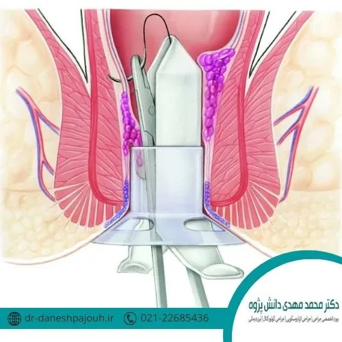 مقایسه لیرز هموروئید و جراحی سنتی