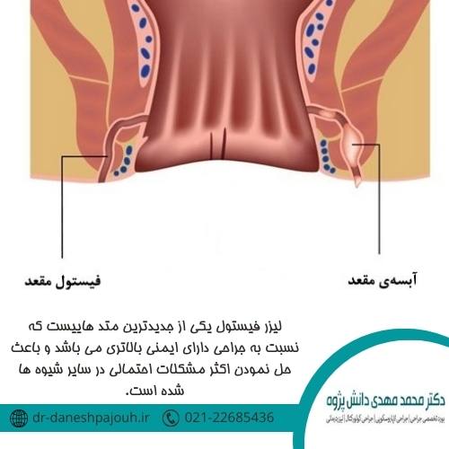 درمان فیستول با لیزر