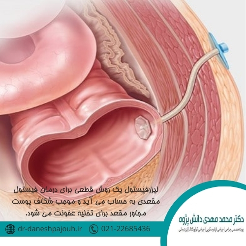 مزیت های روش لیزر فیستول نسبت به جراحی سنتی