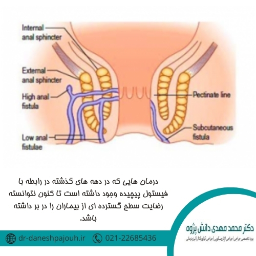 درمان فیستول پیچیده