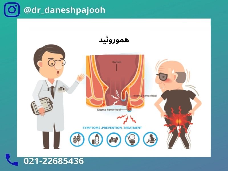 روش های درمان بواسیر - دکتر دانش پژوه