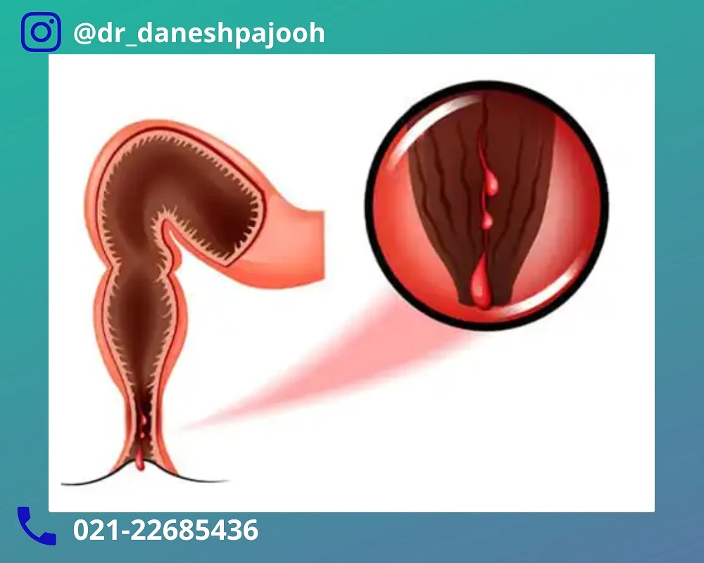 روش های جلوگیری از شقاق مقعدی