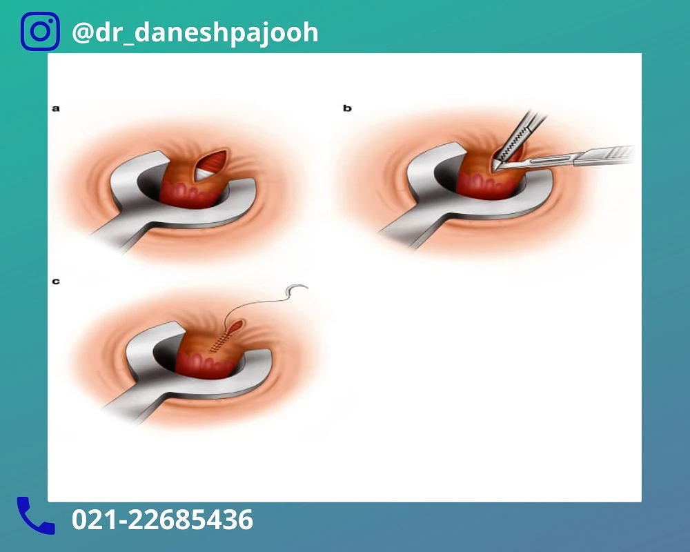 مراقبت‌ های بعد از عمل سنتی و لیزر 