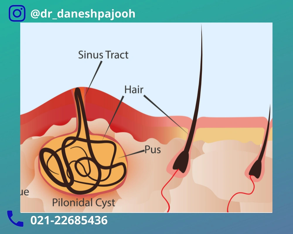 درمان کیست مویی مقعد