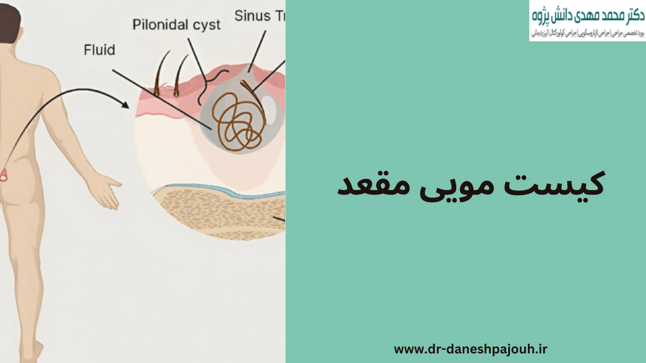 کیست مویی مقعد