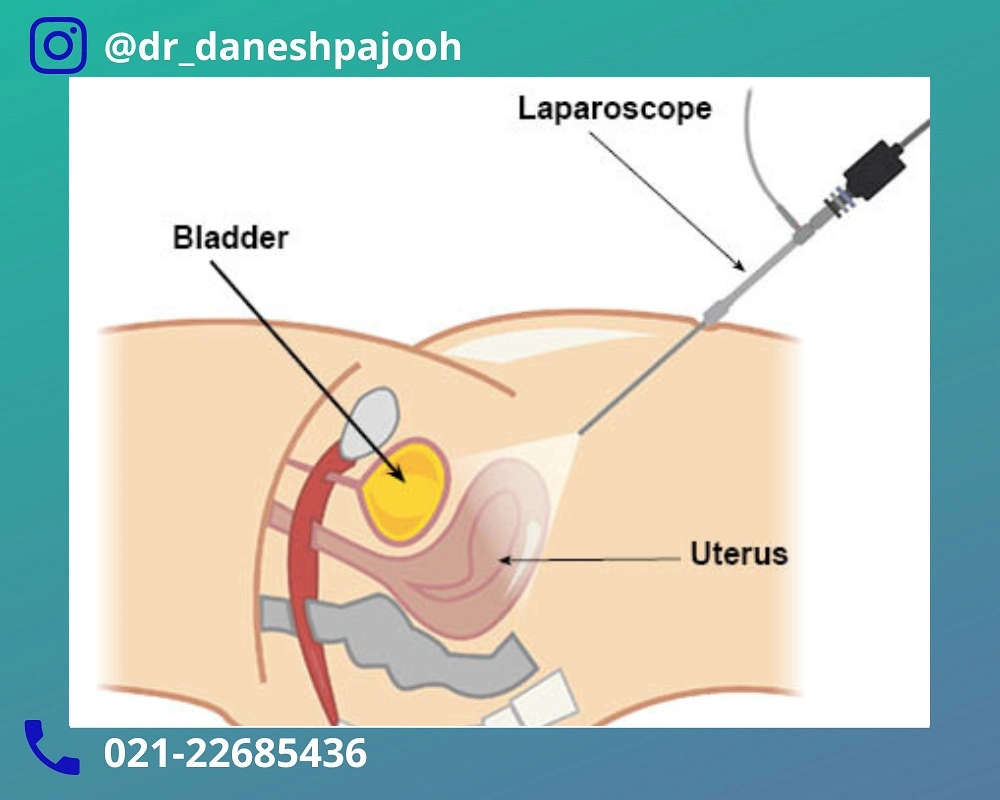 بهترین دکتر لاپاراسکوپی