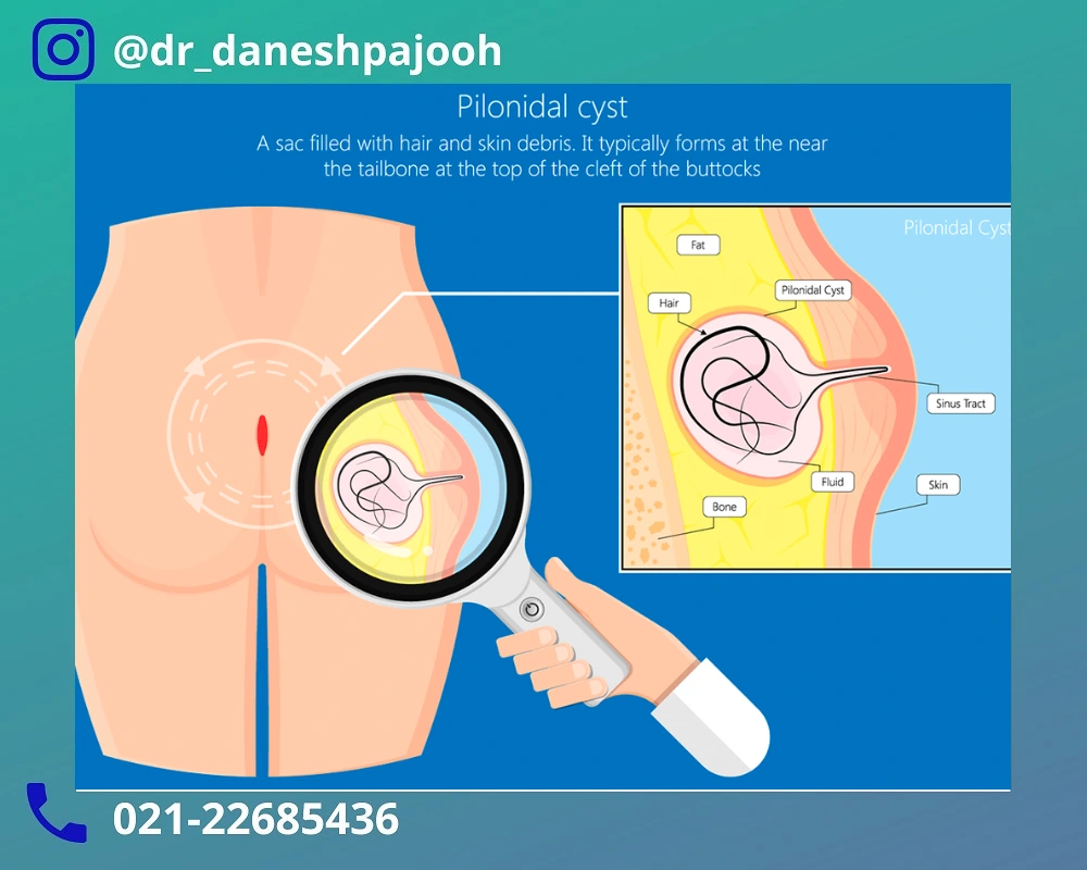 دلایل ایجاد کیست مویی مقعد