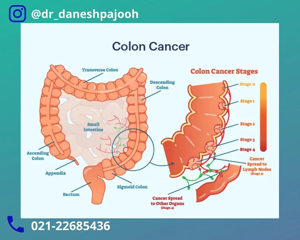 انواع جراحی سرطان روده بزرگ