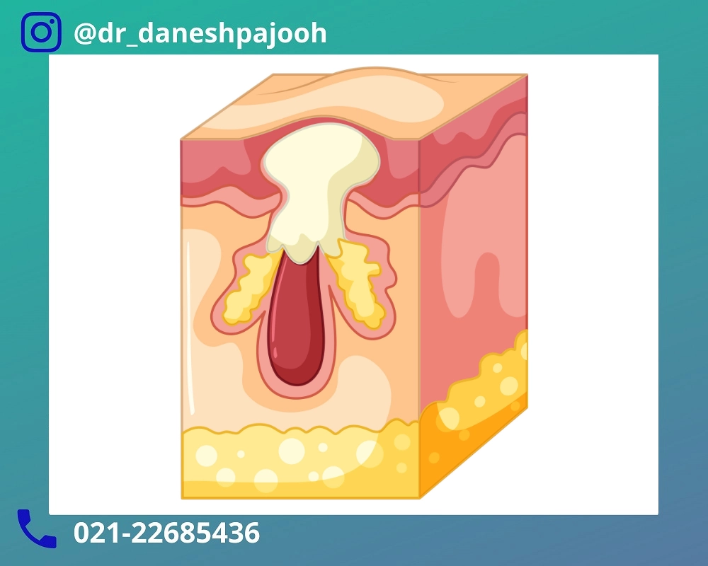 کیست درموئید