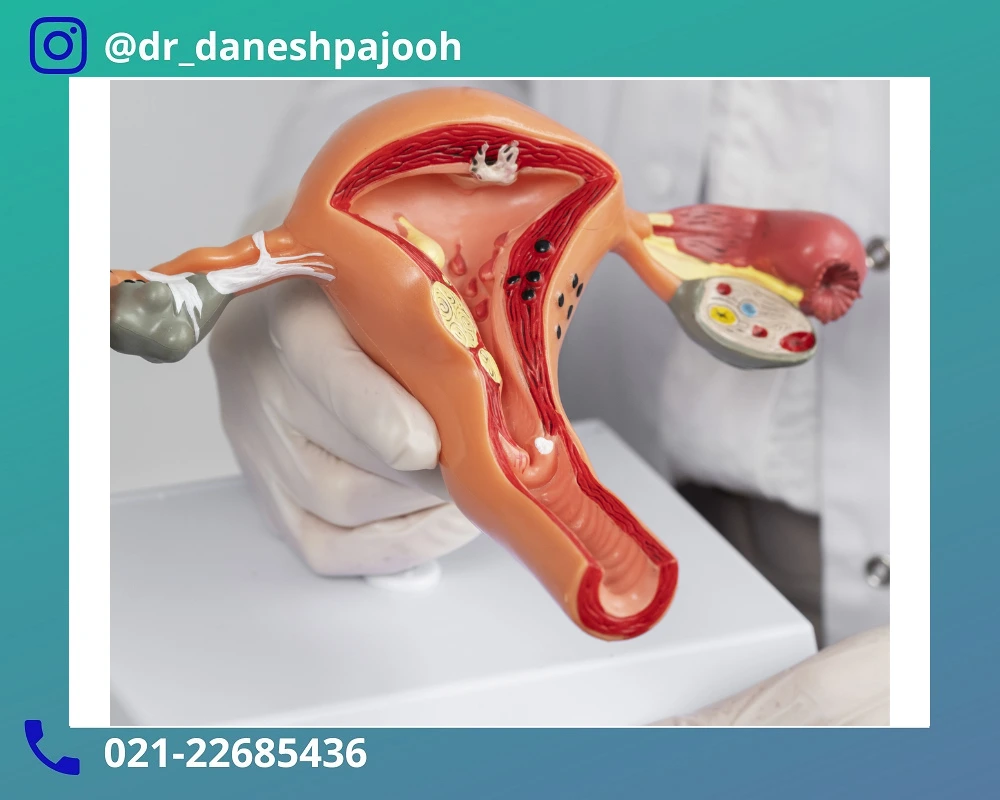 جراحی-کیست-درموئید-تخمدان-1