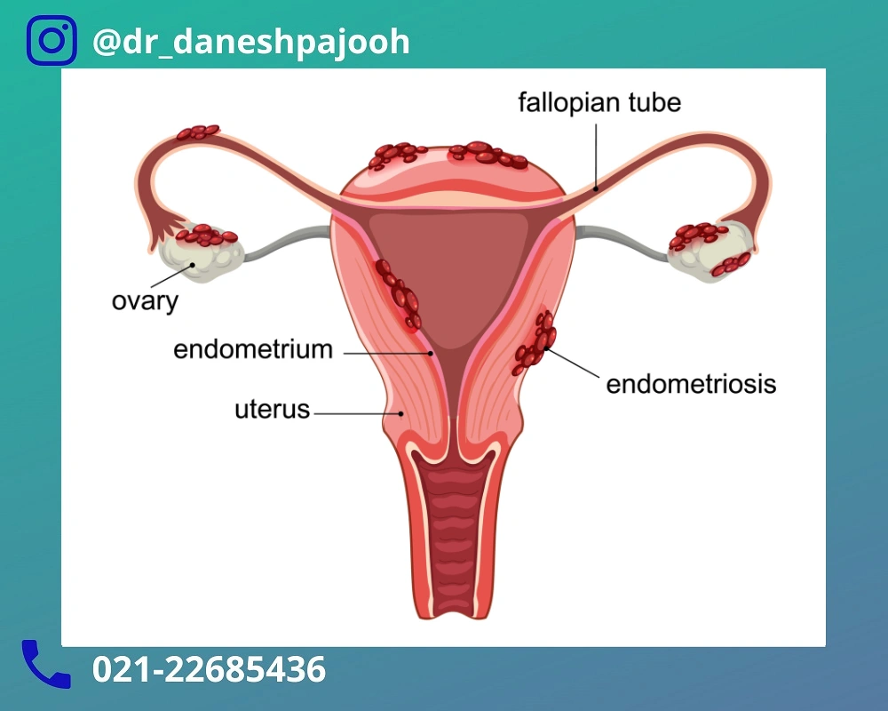 درمان-کیست-درموئید-تخمدان-1