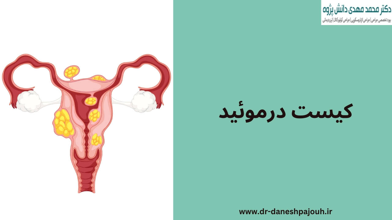 کیست درموئید تخمدان