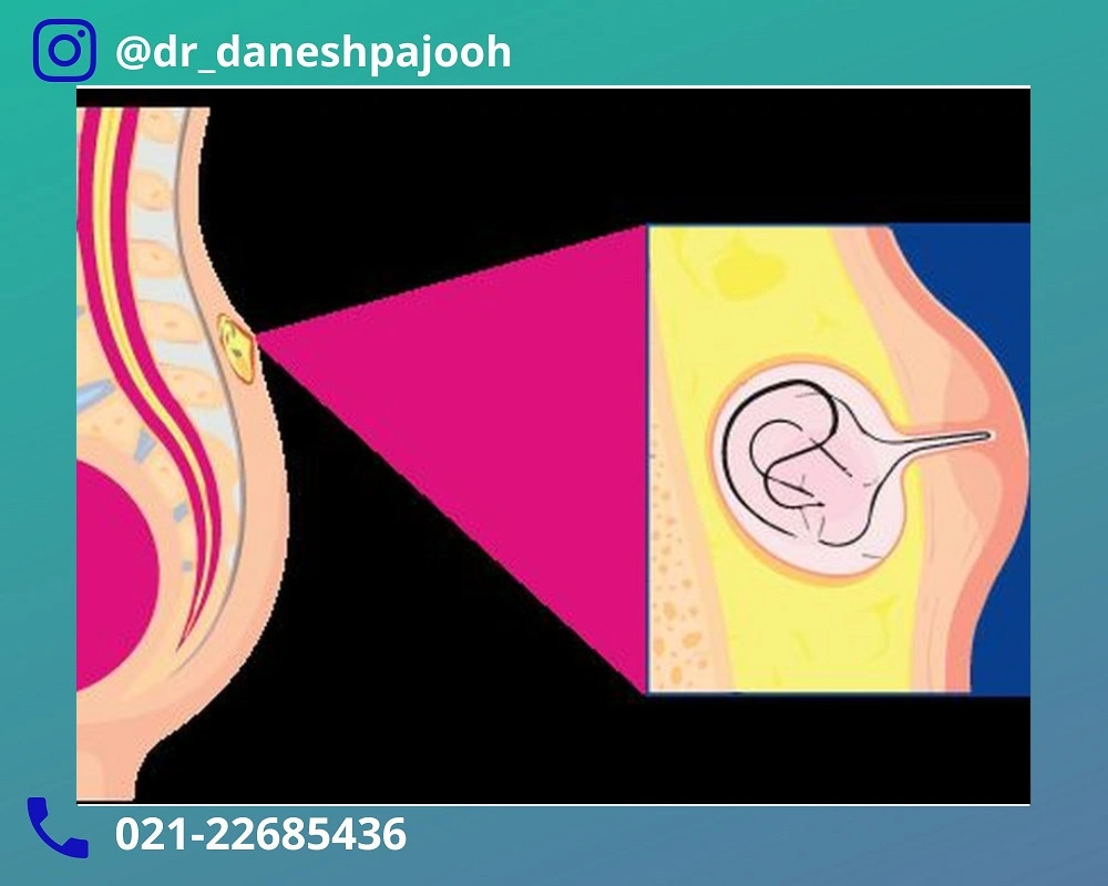 درمان کیست مویی با لیزر