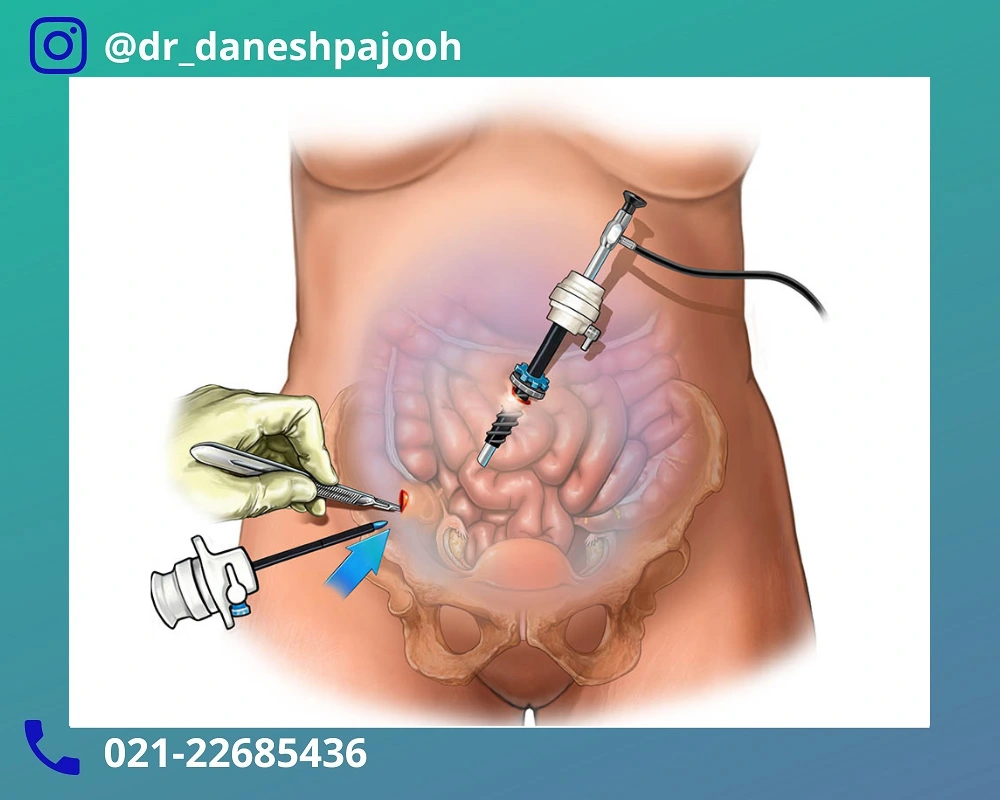 داروهای مراقبت های بعد از عمل لاپاراسکوپی