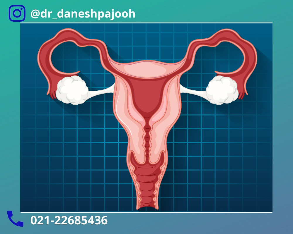علائم کیست درموئید تخمدان
