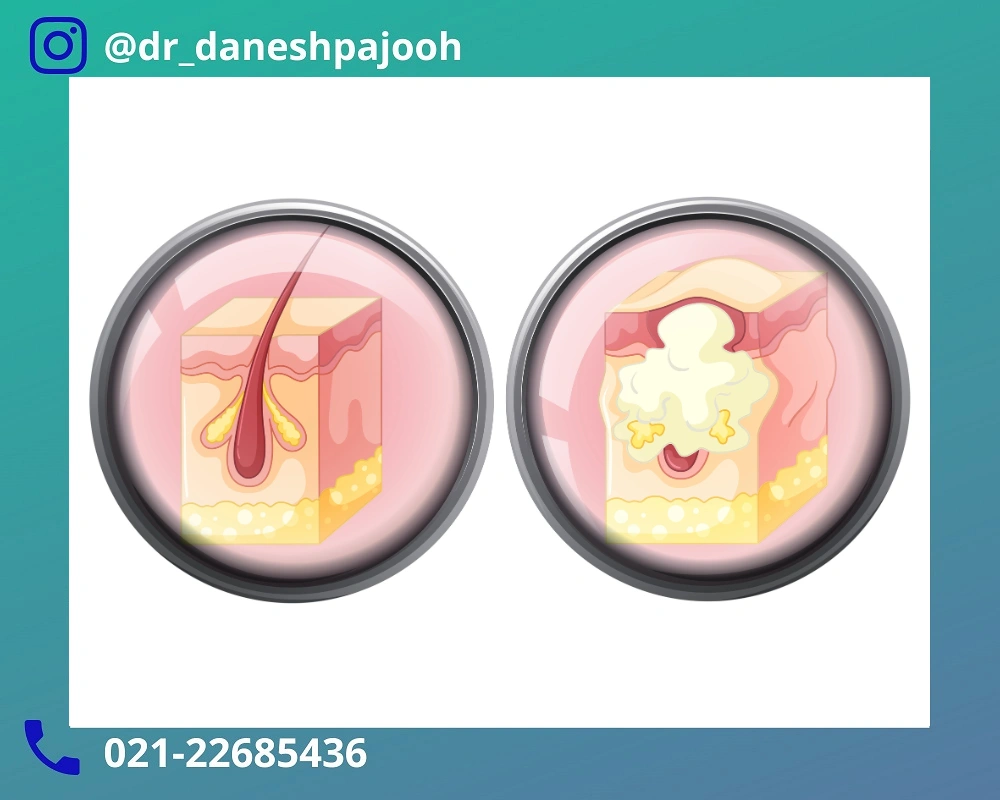 انواع کیست درموئید