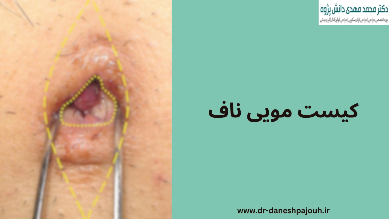 کیست مویی ناف