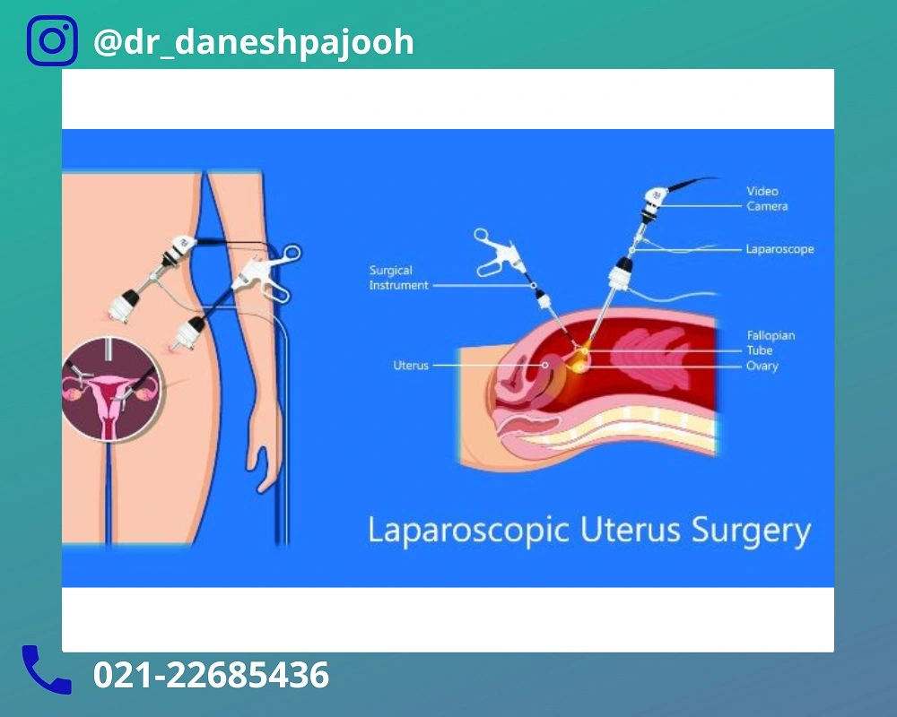 مراقبت های بعد از عمل لاپاراسکوپی زنان