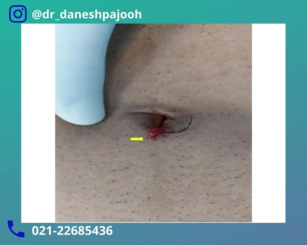 تشخیص کیست مویی ناف