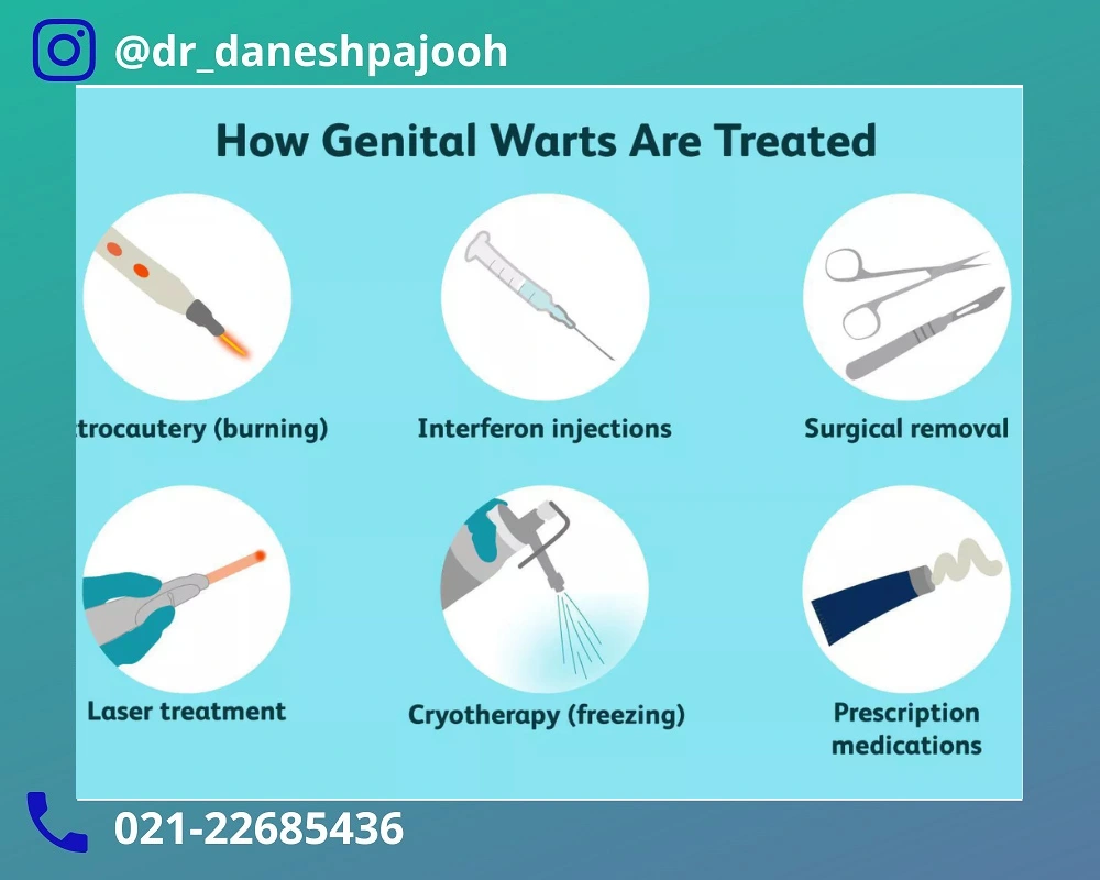 روش های درمان زگیل تناسلی