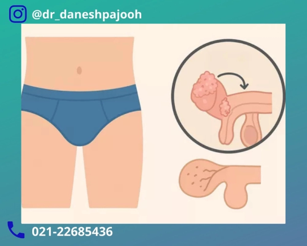 درمان زگیل تناسلی مردان در کلینیک دانش پژوه