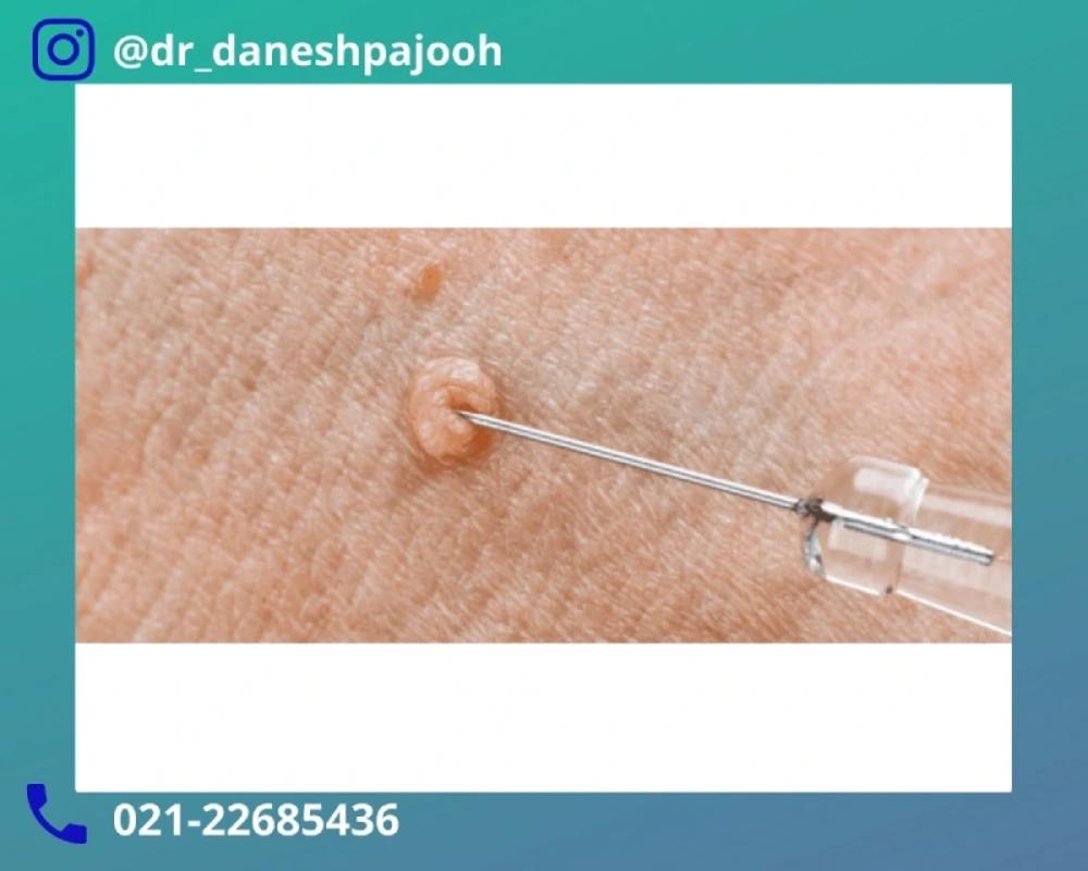 دارو درمان زگیل تناسلی مردان