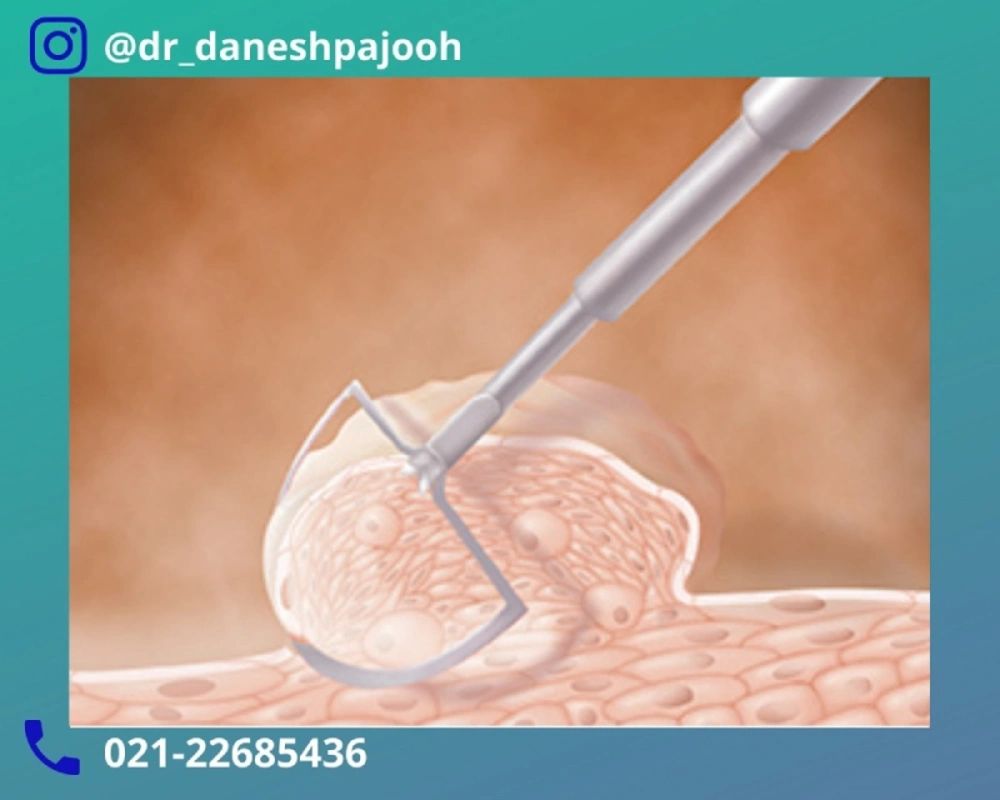 روش های درمان زگیل تناسلی مردان