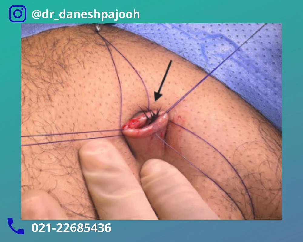 درمان کیست مویی ناف