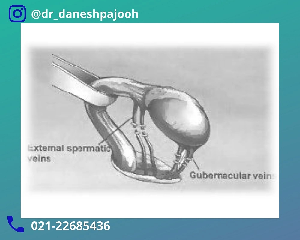 مزایای لاپاراسکوپی واریکوسل