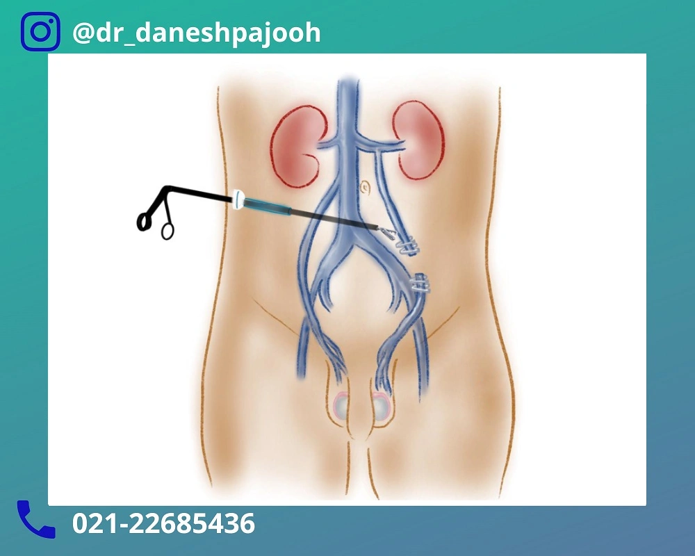 تاثیر لاپاراسکوپی واریکوسل