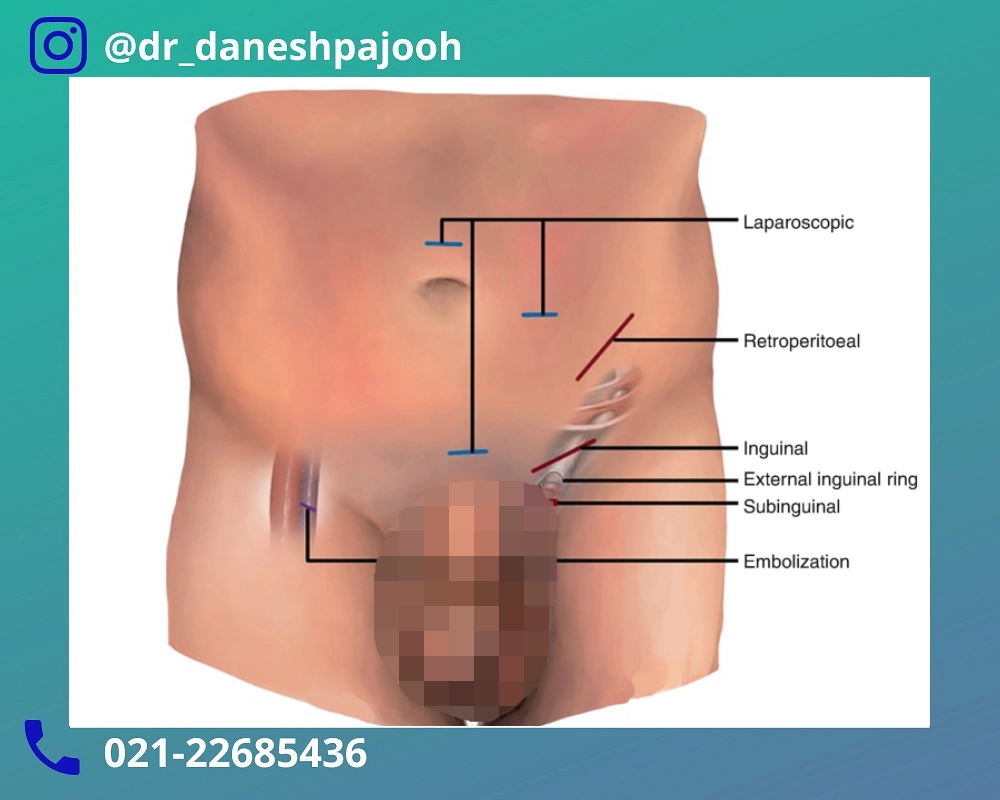 آماده سازی لاپاراسکوپی واریکوسل