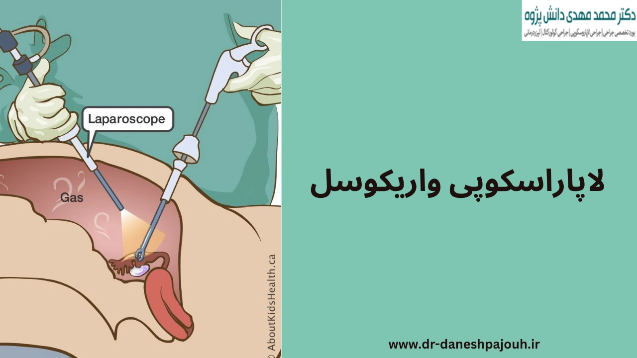 لاپاراسکوپی واریکوسل