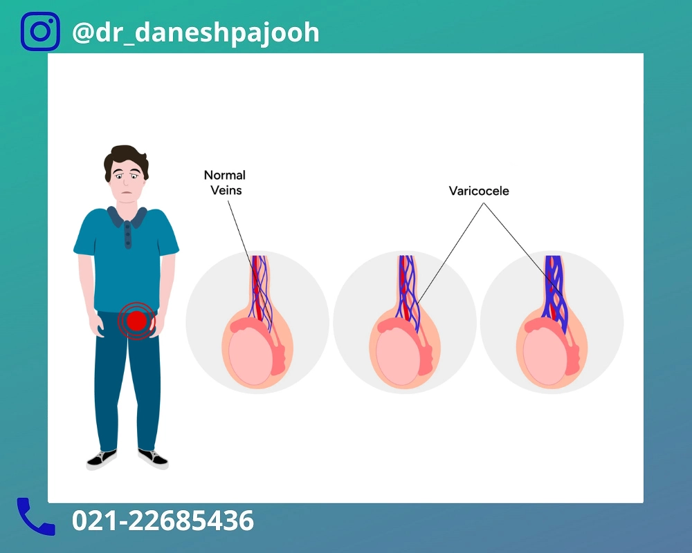 پیشگیری واریکوسل