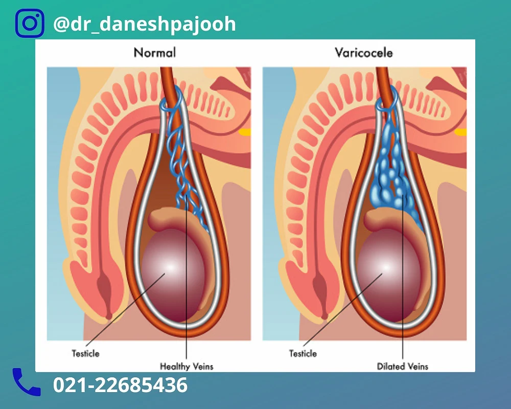 علت واریکوسل