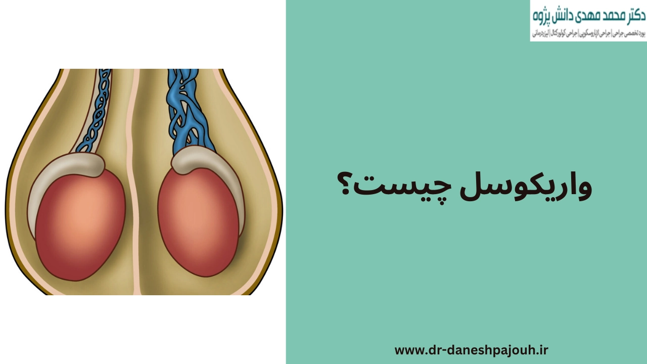 واریکوسل