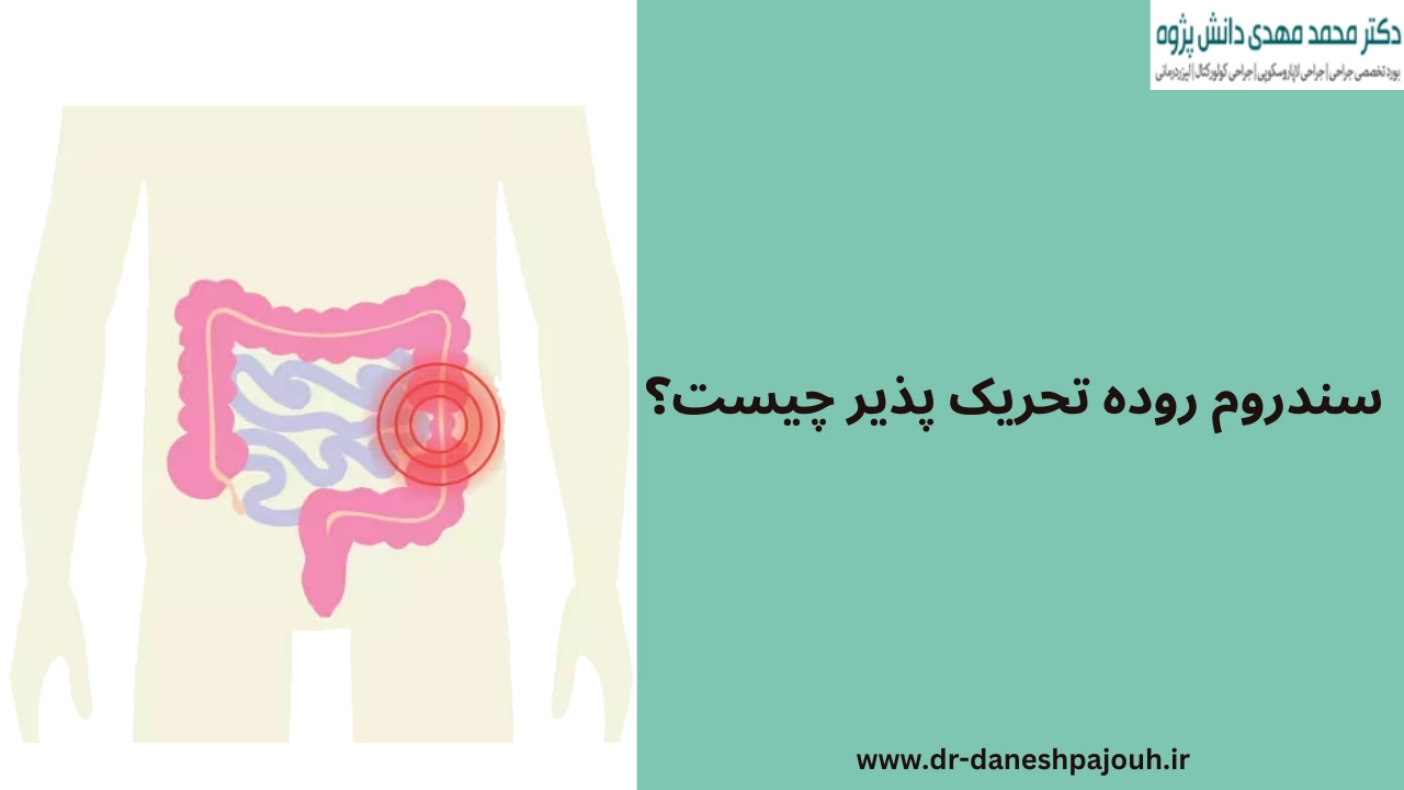 سندروم روده تحریک پذیر